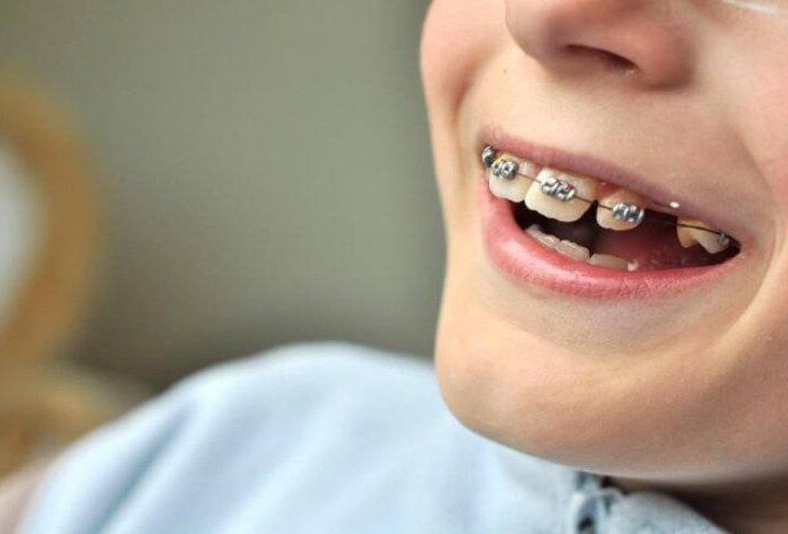 МӘМС аясында балаларға тіс импланттары салынбайды